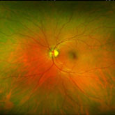 Optomap High Definition Retinal Photography